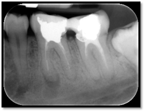 Root canal retreatment and bypass - Pre-op case